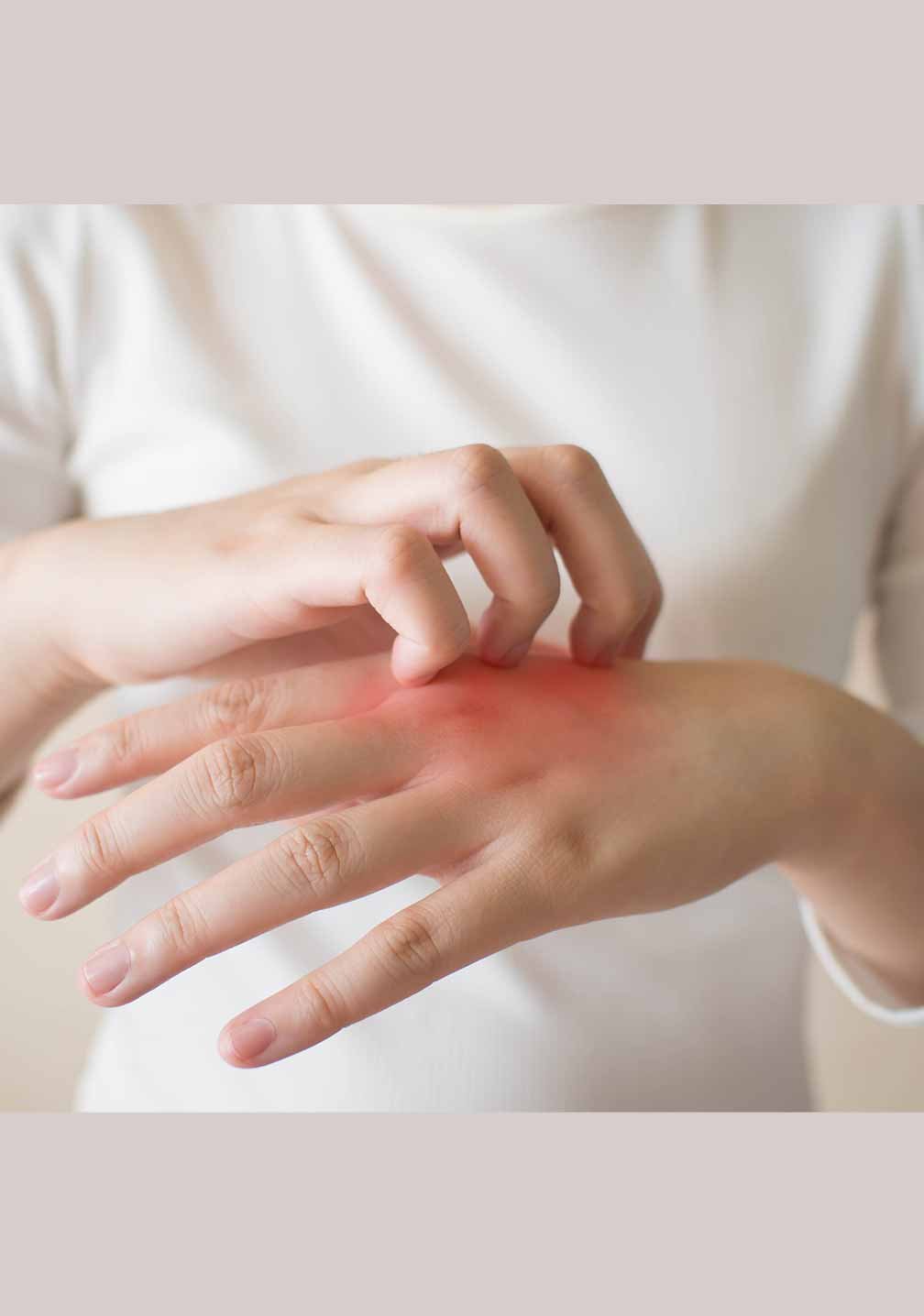 Nahaufnahme einer Hand mit Rötungen, die auf Hautirritation deutet, passend zu RAU Cosmetics Handdesinfektionsgel.