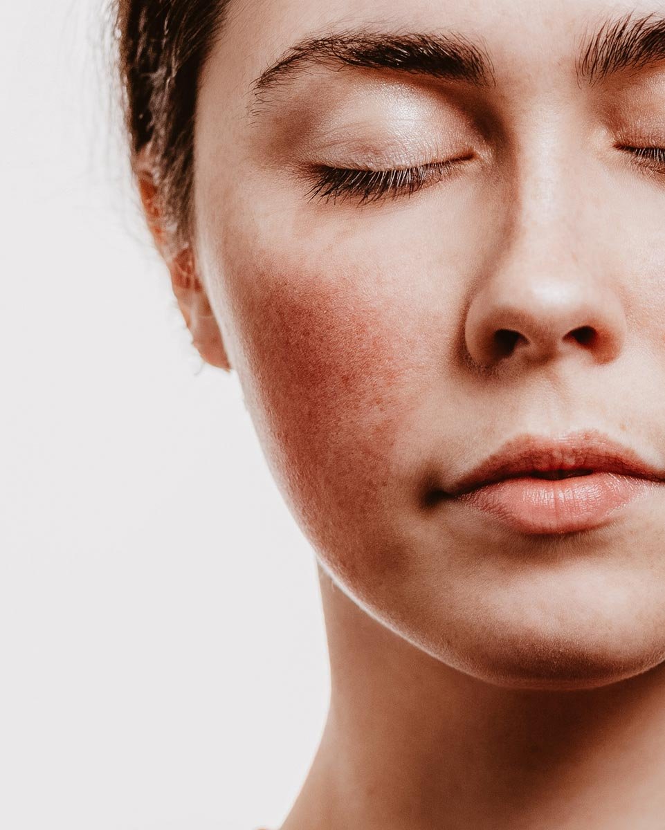 Nahaufnahme eines Gesichts mit geschlossenen Augen, zeigt Rötungen und Anzeichen von Couperose, passend zum Thema der Hautpflege und Fruchtsäurebehandlungen.