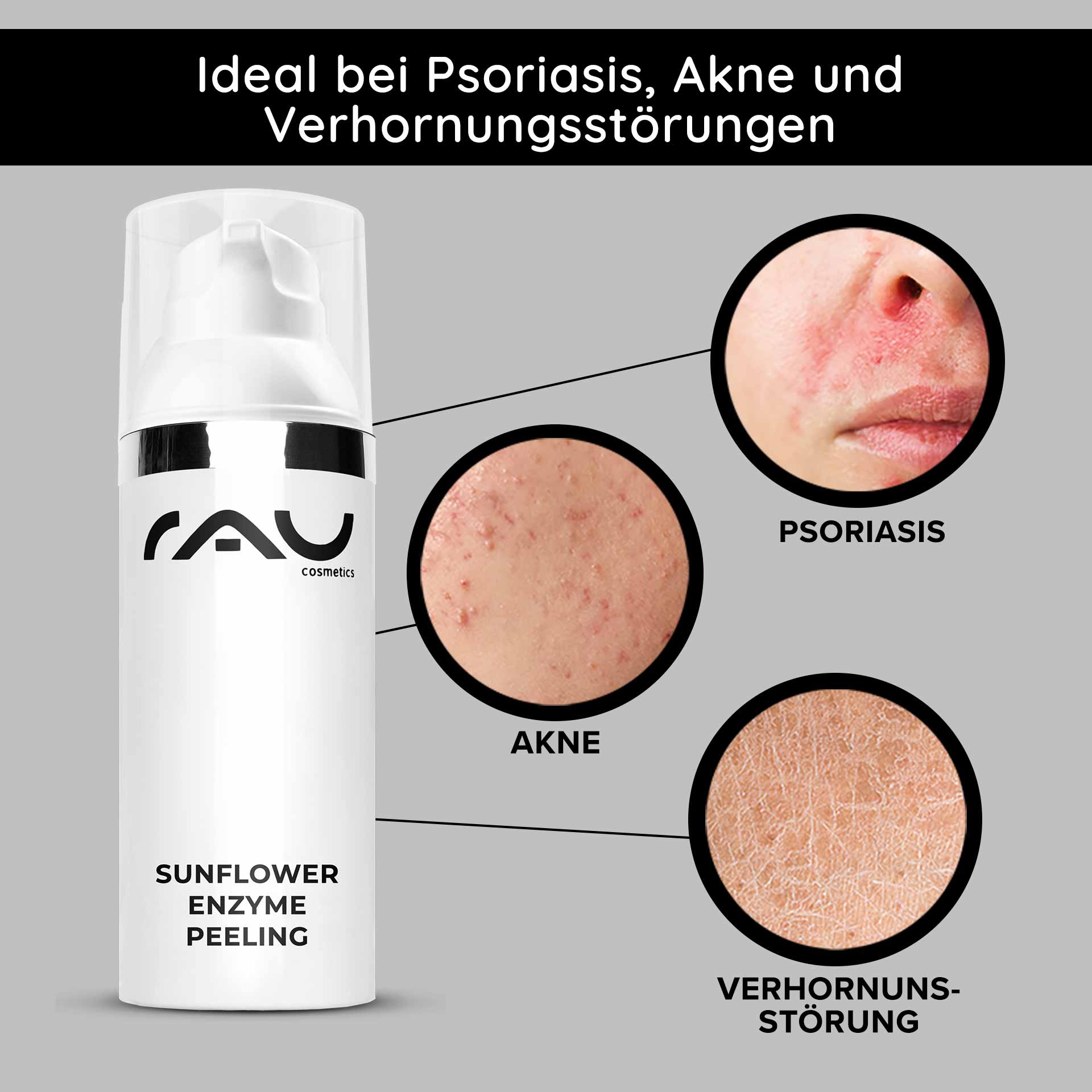 Sunflower Enzyme Peeling 50 ml Chemical Enzyme Peeling Verpackung des Sunflower Enzyme Peeling von RAU Cosmetics mit hervorgehobenen Hautproblemen: Schuppenflechte, Akne und Hyperkeratose.