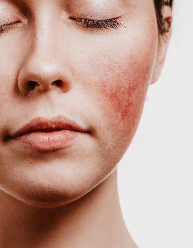 Nahaufnahme eines Gesichts mit sichtbarer Couperose, rötliche Hautpartien um die Wangen, Augen geschlossen, Fokus auf Hautpflege für empfindliche Haut.