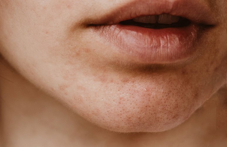 Hautunreinheiten und Pickel im Kinnbereich nach dem Absetzen der Pille, symbolisierend hormonelle Veränderungen und Hautprobleme.