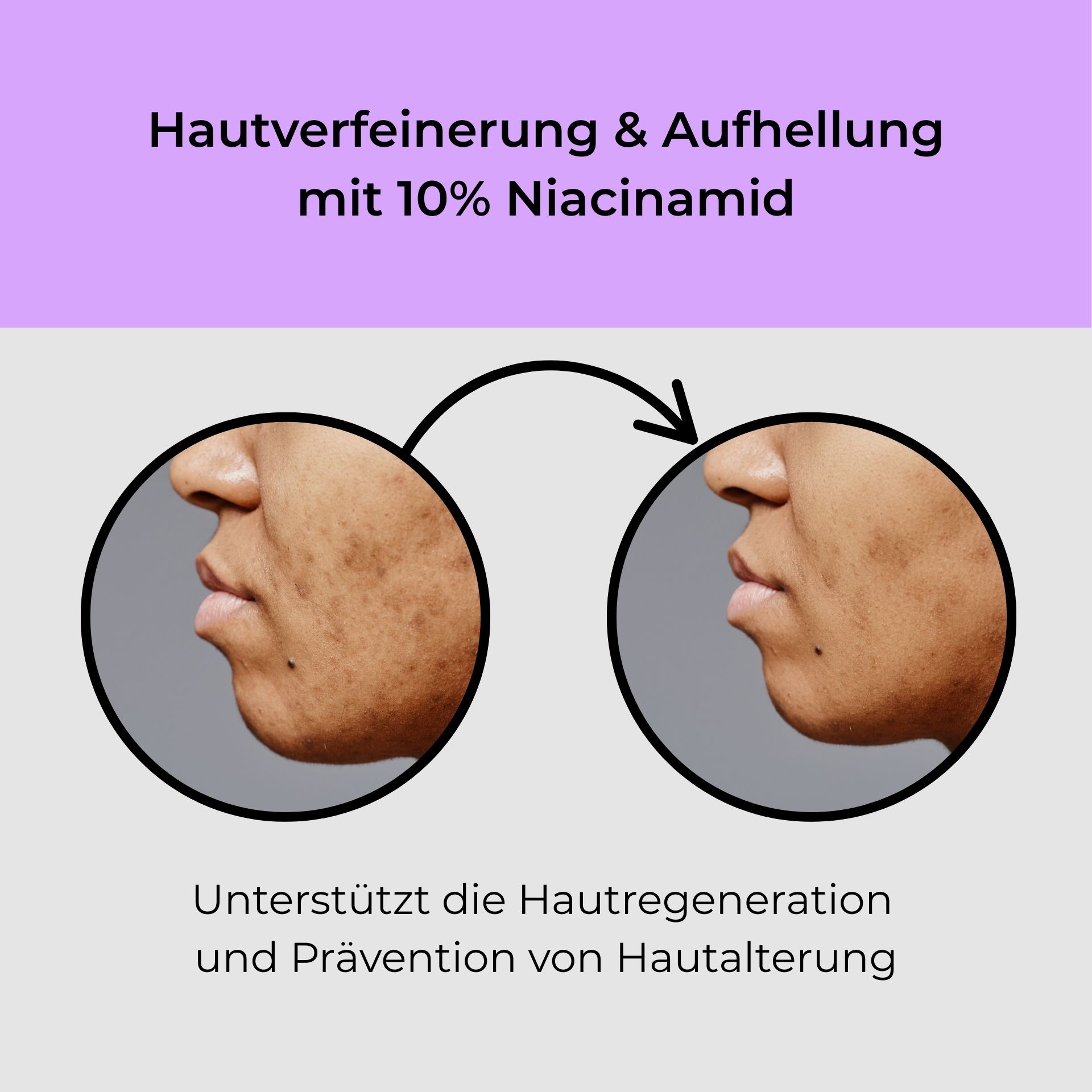 Niacinamide & Astaxanthin Serum Roll-On 10 ml Hautverfeinerung und Aufhellung mit 10% Niacinamid, Vorher-Nachher-Bilder der Hauttextur, Unterstützung der Hautregeneration und Prävention von Hautalterung.
