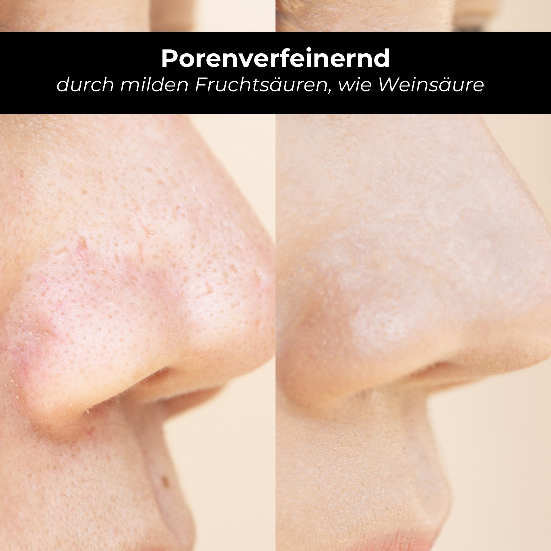 Verfeinerte Poren: Vorher-Nachher Vergleich des Hautbildes nach der Anwendung von Weinsäure und Fruchtsäuren.