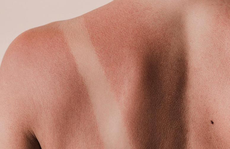rau-cosmetics-after-sun-02 Sonnenbrand auf der Schulter mit deutlichem Farbunterschied zwischen gebräunter und ungeschützter Haut, passend zum Thema After Sun Pflege und Sonnenbrandbehandlung.