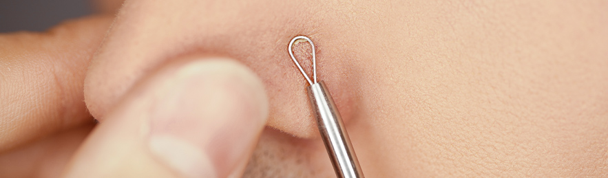 Blackheads and Skin Care